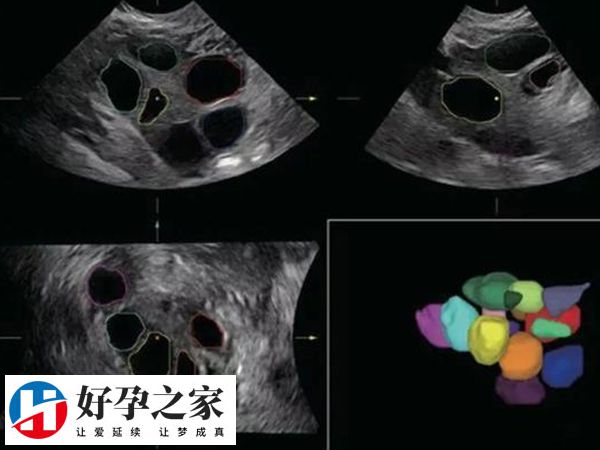 多囊是一种常见内分泌代谢性疾病