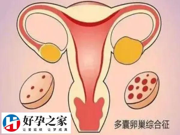多囊会不排卵