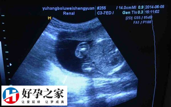生活方式不健康会导致多囊