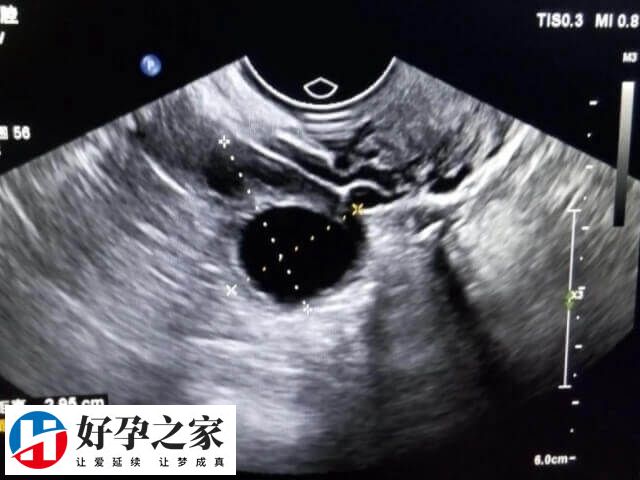 子宫内膜环境好着床几率高