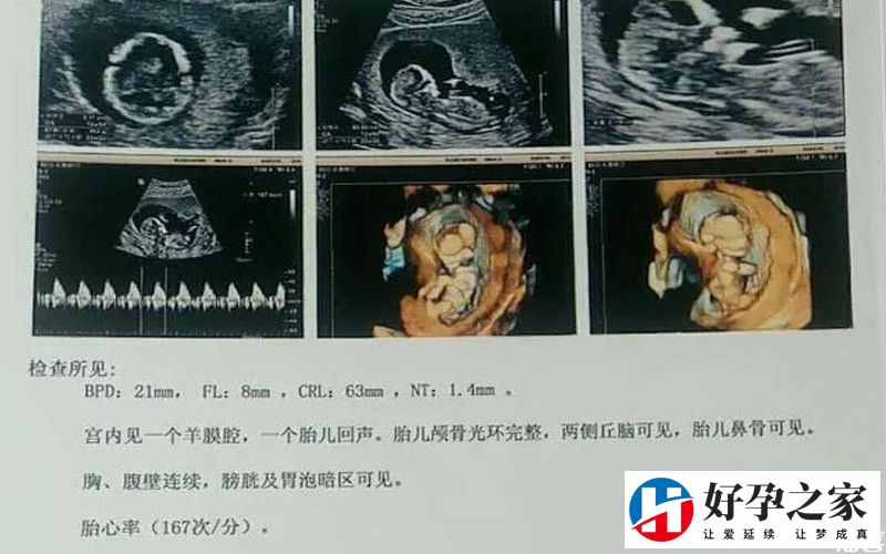 nt检查用于判断胚胎发育情况