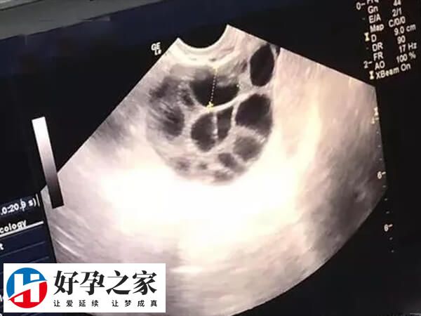 卵泡黄素化会导致卵泡变小