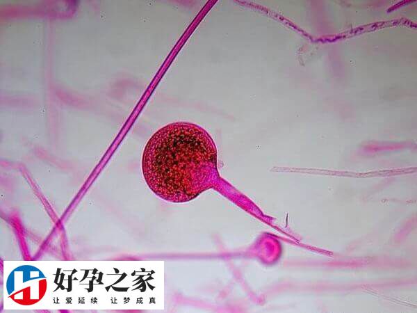 抗精子抗体会造成不孕