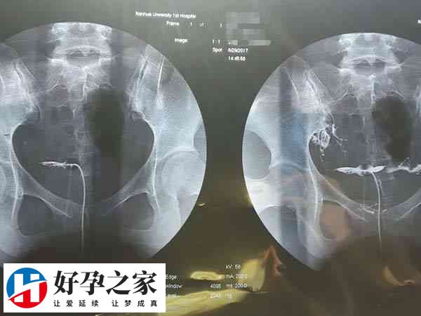 检查输卵管的状况是非常重要的