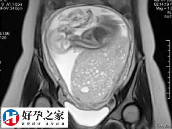 做试管检查b超的作用很多