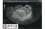 促排双胞胎需不需要减胎