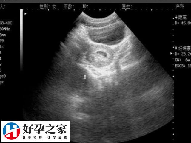 胎盘低置避免下蹲